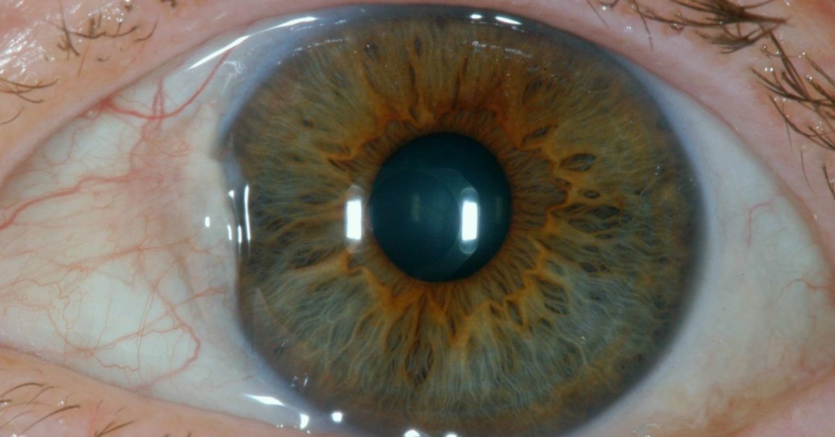 Six Things to Know about Pinguecula and Pterygium